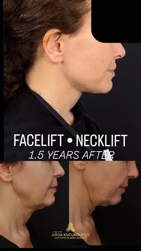 Before and after deep plane facelift, frontal view by Dr. Arda Küçükgüven