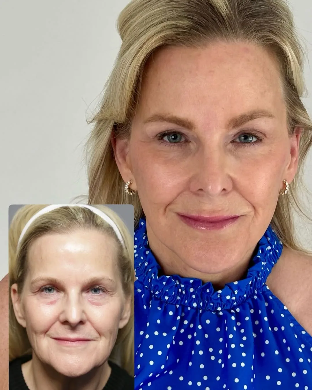 Before and after deep plane facelift — 30-year-old woman, frontal view, 16mo post-op by Dr. Ariel Rad