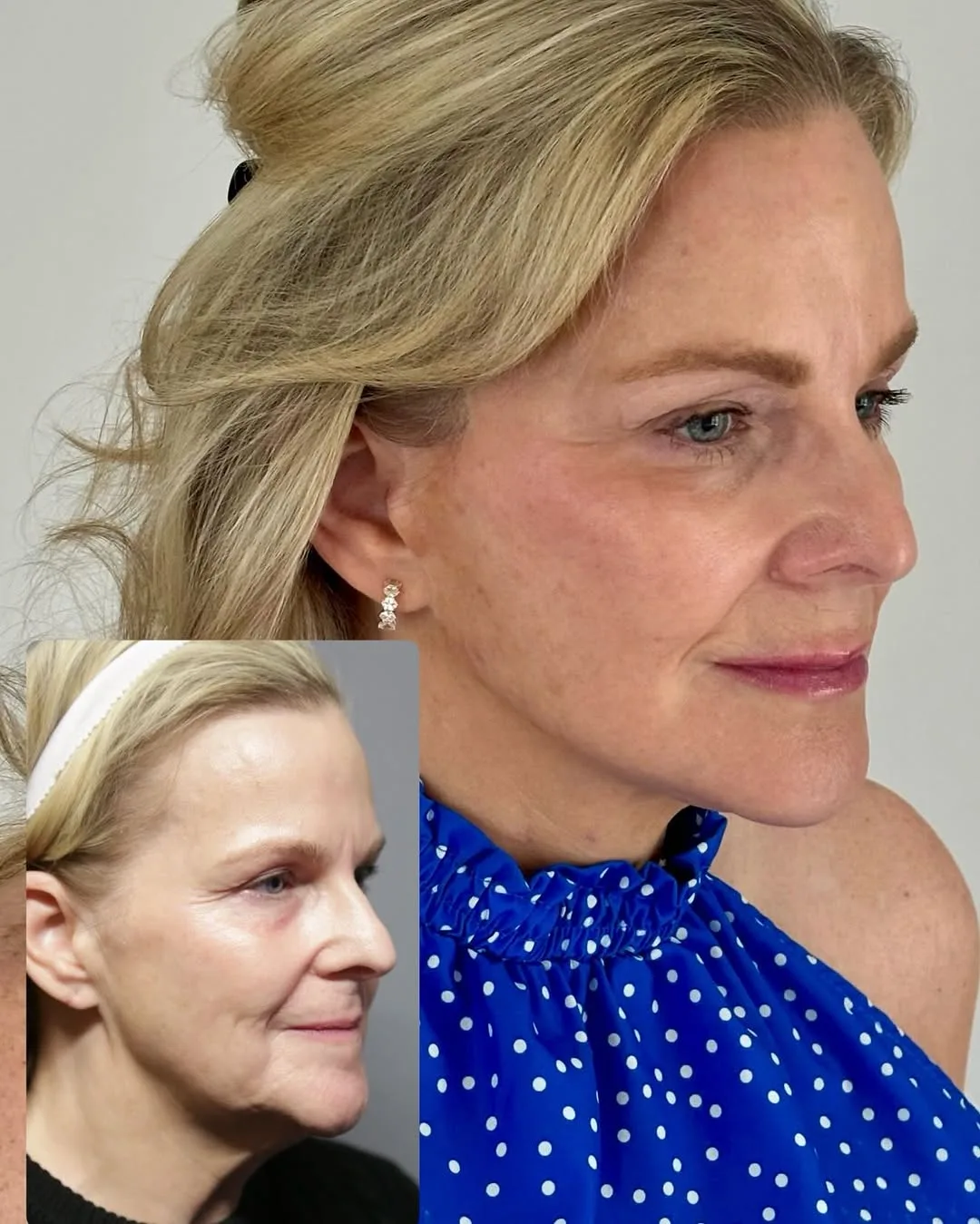 Before and after deep plane facelift — 30-year-old woman, three-quarter view, 16mo post-op by Dr. Ariel Rad