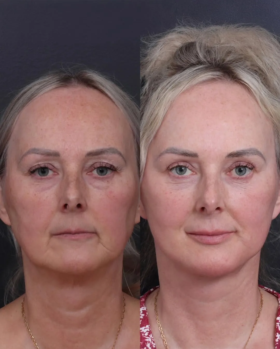 Before and after deep plane facelift — 55-year-old woman, frontal view, 2mo post-op by Dr. Ariel Shomorony