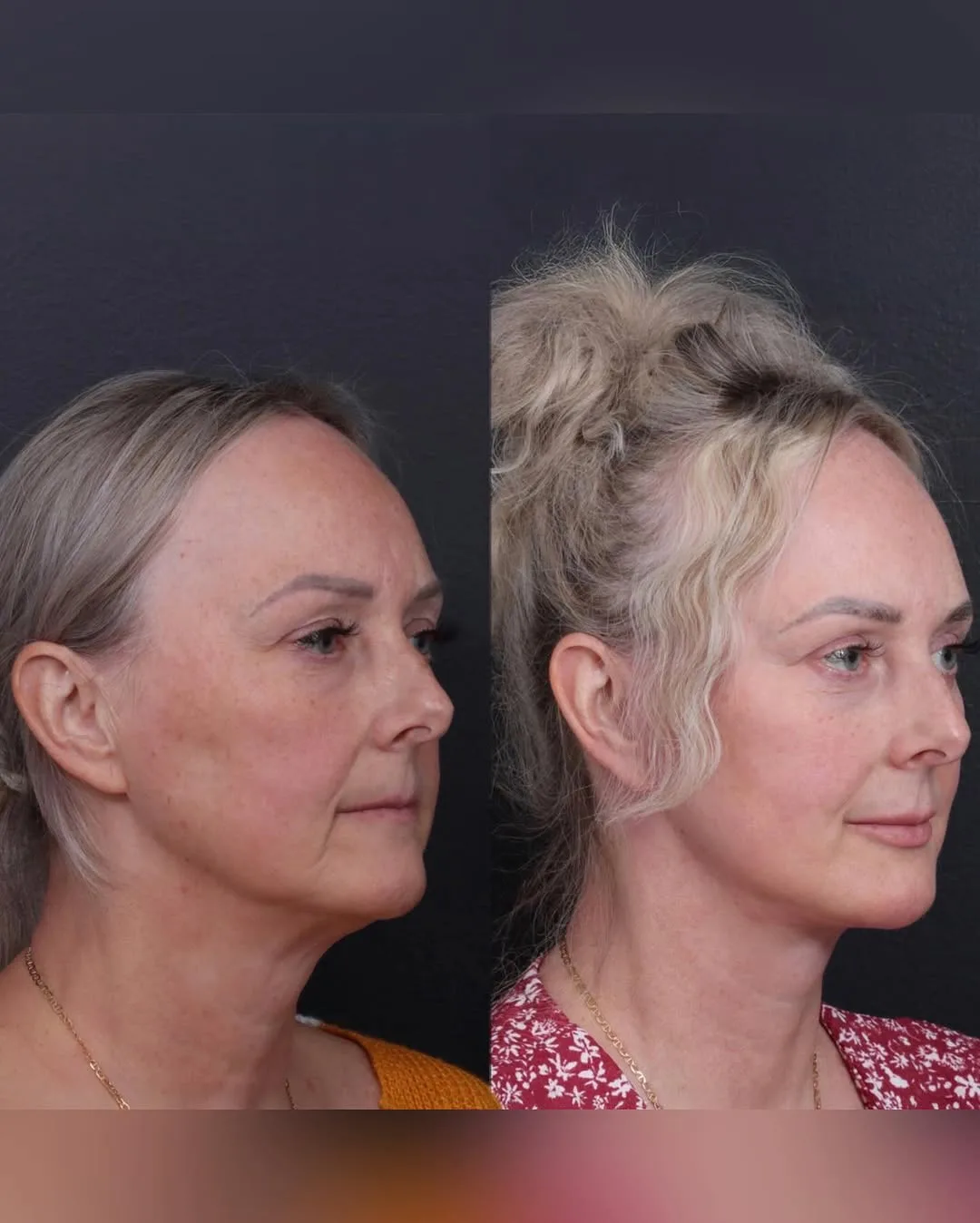 Before and after deep plane facelift — 55-year-old woman, three-quarter view, 2mo post-op by Dr. Ariel Shomorony