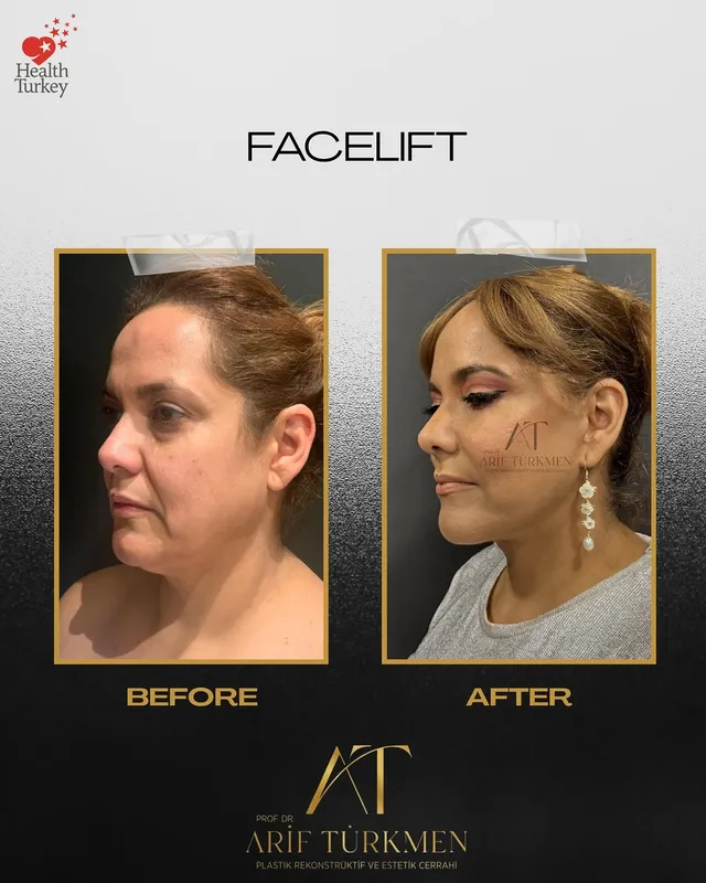 Before and after — Prof. Arif Türkmen