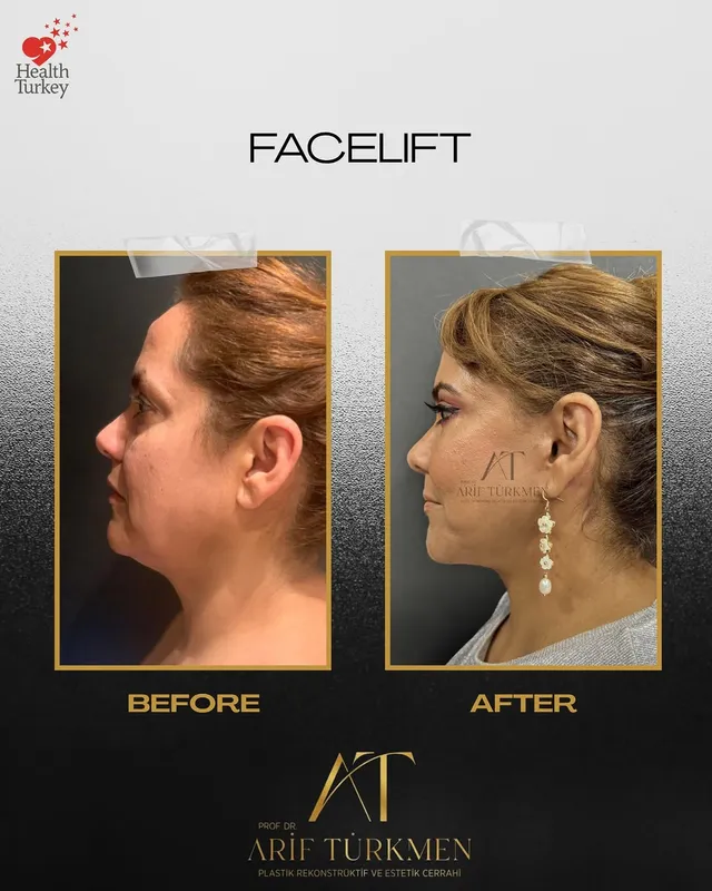Before and after — Prof. Arif Türkmen