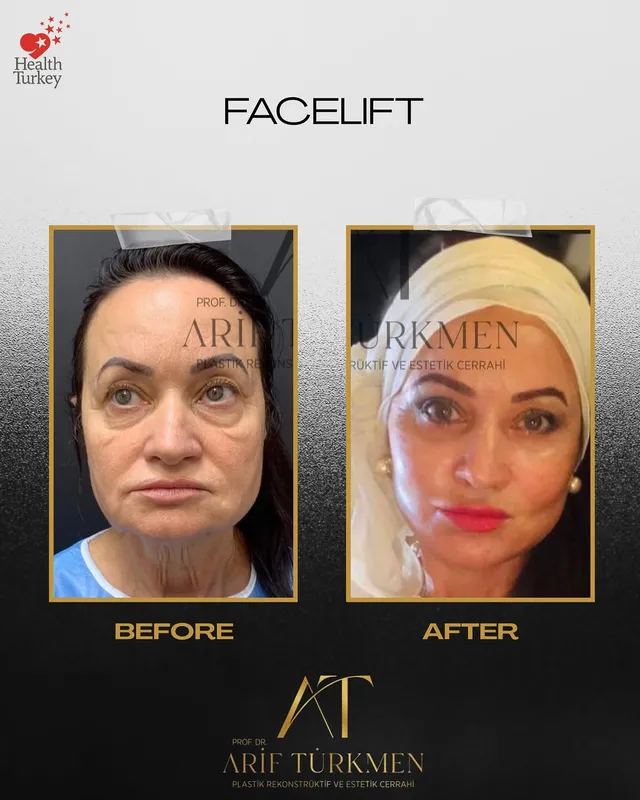 Before and after — Prof. Arif Türkmen