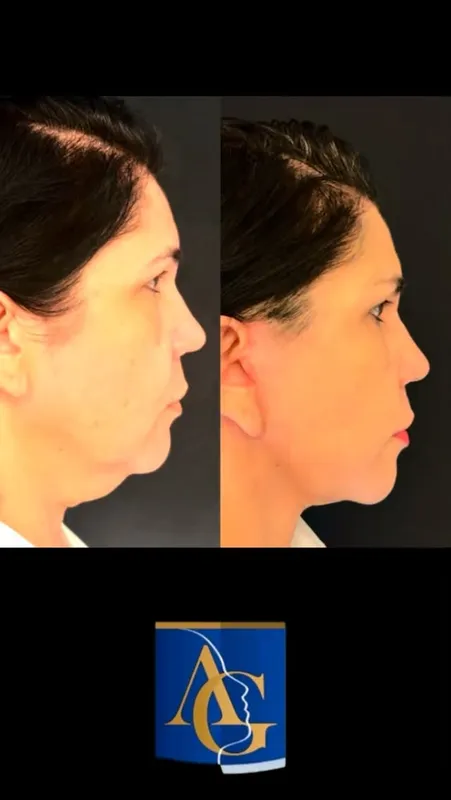 Before and after deep plane facelift, frontal view by Dr. Artur Grinfeld