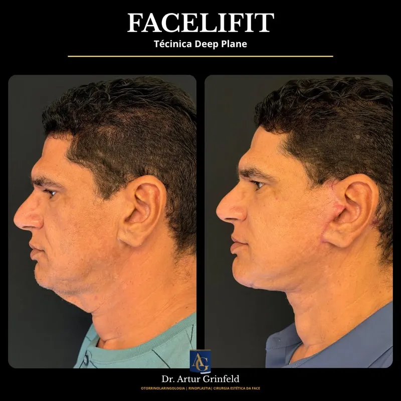 Before and after deep plane facelift, frontal view by Dr. Artur Grinfeld