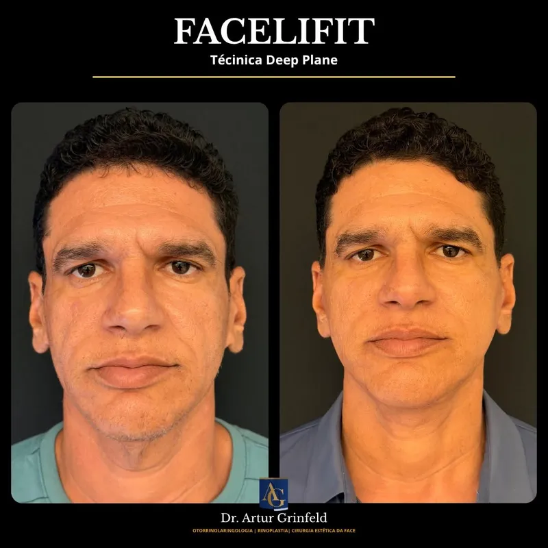 Before and after deep plane facelift, frontal view by Dr. Artur Grinfeld