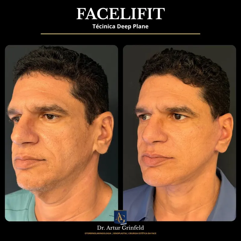 Before and after deep plane facelift, frontal view by Dr. Artur Grinfeld