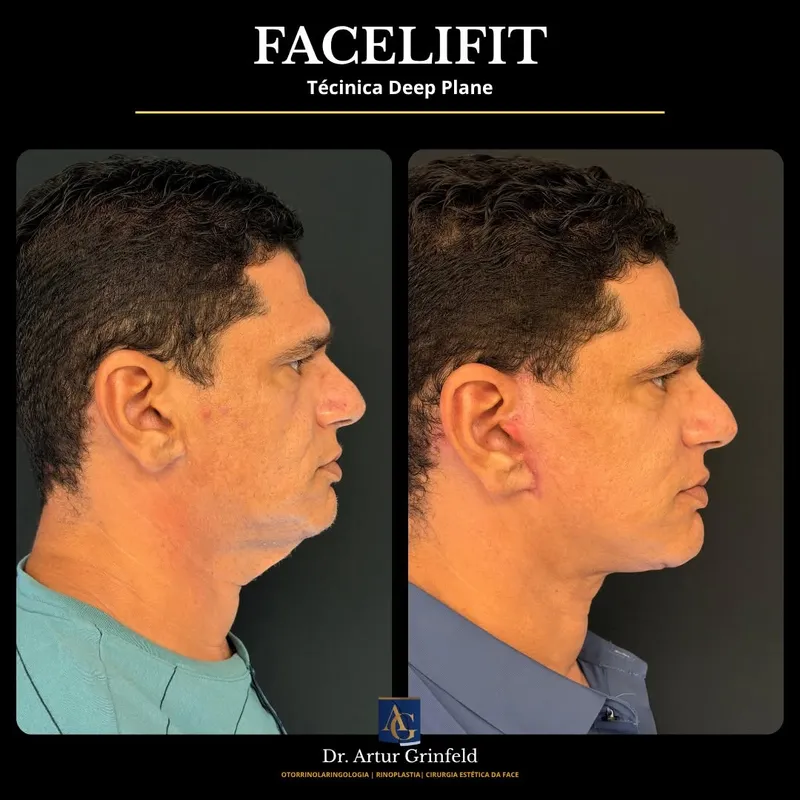 Before and after deep plane facelift, frontal view by Dr. Artur Grinfeld