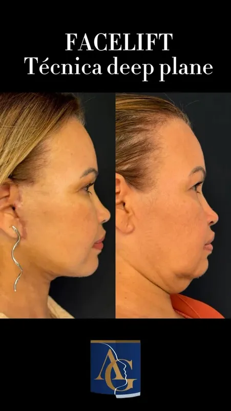 Before and after deep plane facelift, frontal view by Dr. Artur Grinfeld