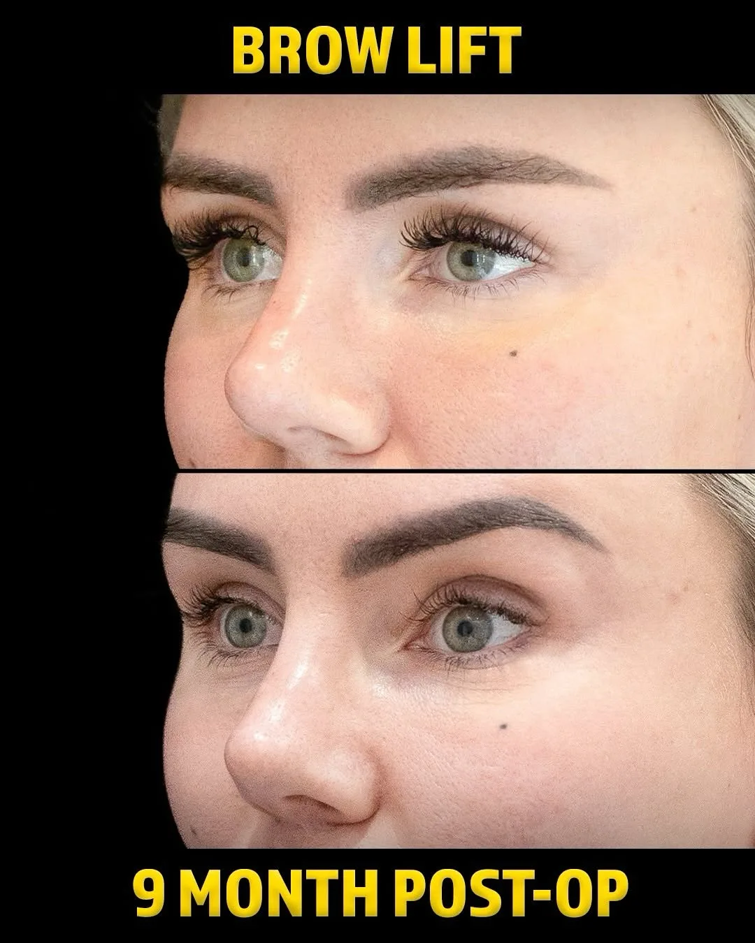 Before and after deep plane facelift — 32-year-old woman, oblique right view, 9mo post-op by Dr. Arturo Franco