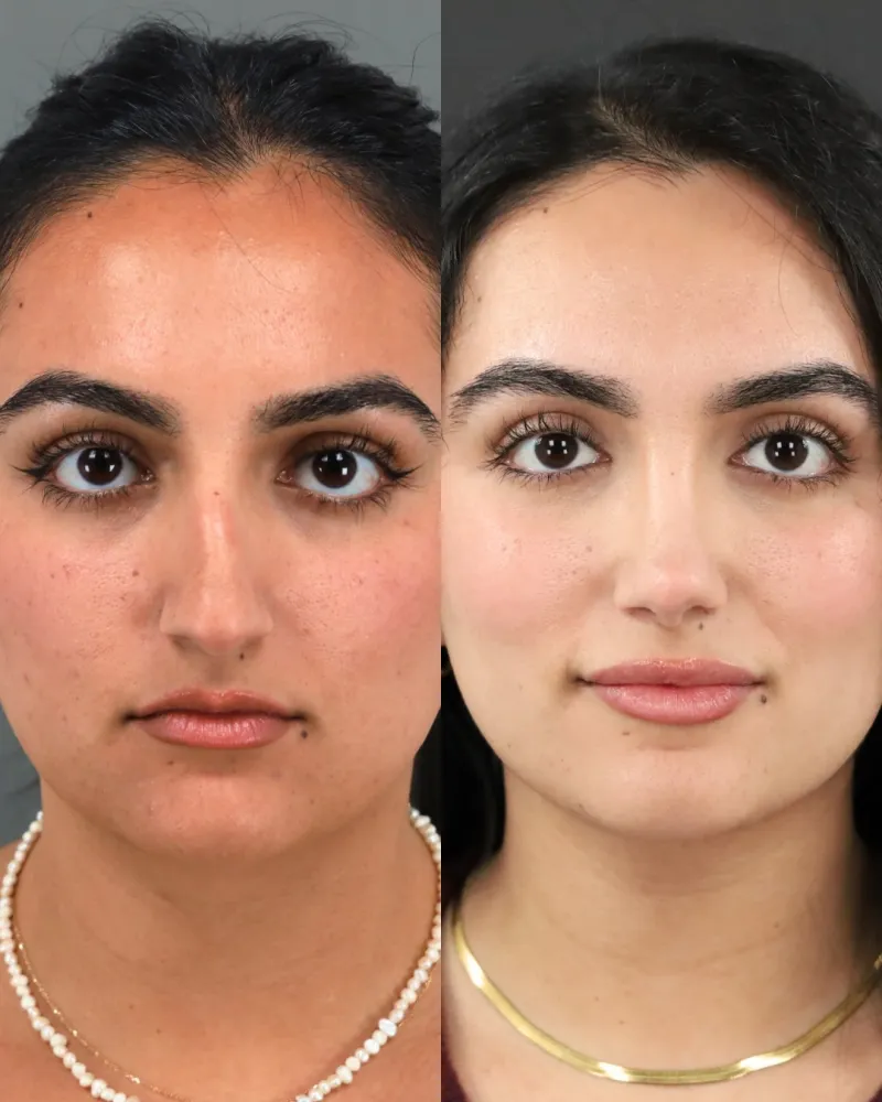 Before and after — Dr. Ashkan Ghavami