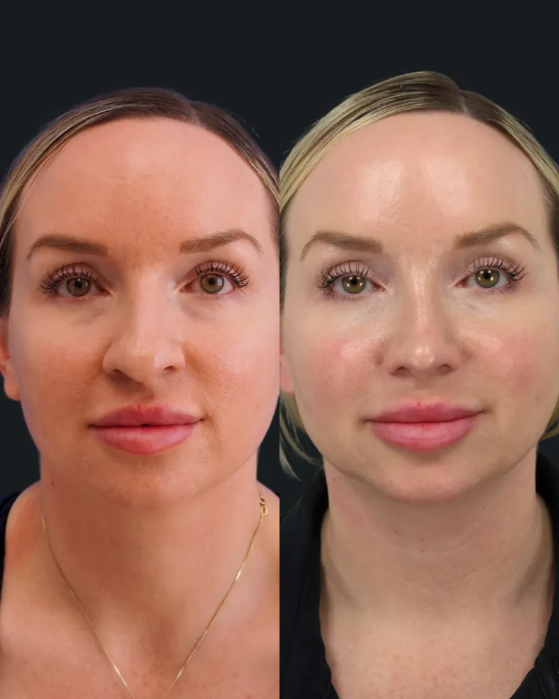 Before and after — Dr. Ashkan Ghavami