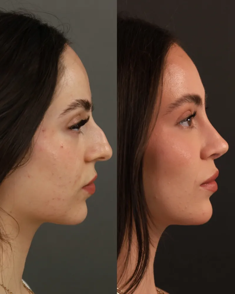 Before and after — Dr. Ashkan Ghavami
