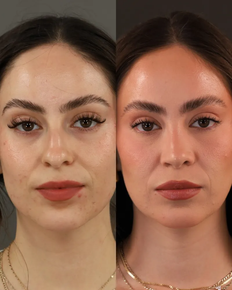 Before and after — Dr. Ashkan Ghavami
