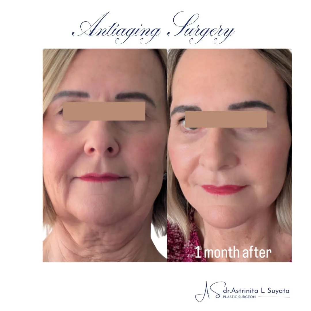 Before and after — Dr. Astri Suyata