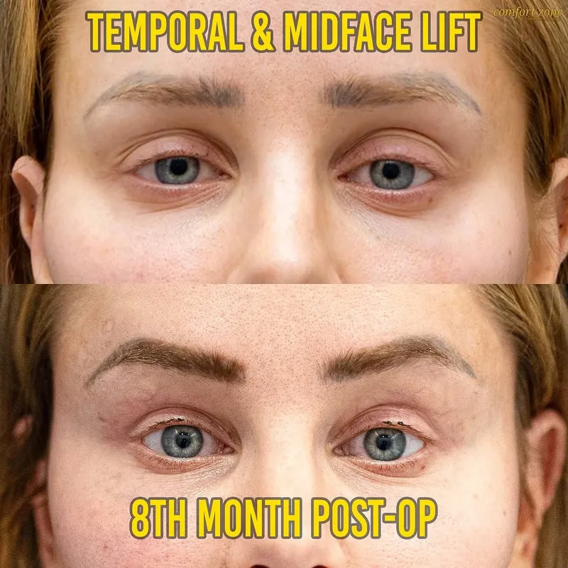 Before and after deep plane facelift — -1-year-old patient, frontal view by Dr. Atıf Cezairlioğlu