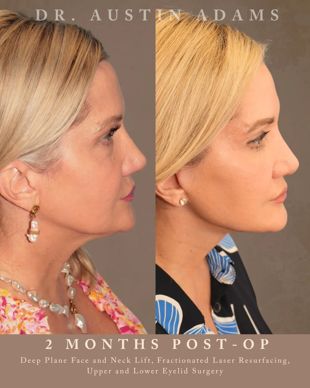 Before and after — Dr. Austin Adams