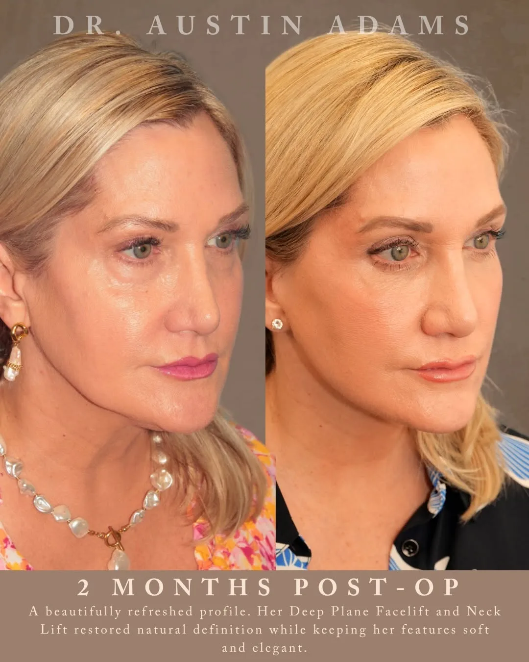Before and after — Dr. Austin Adams