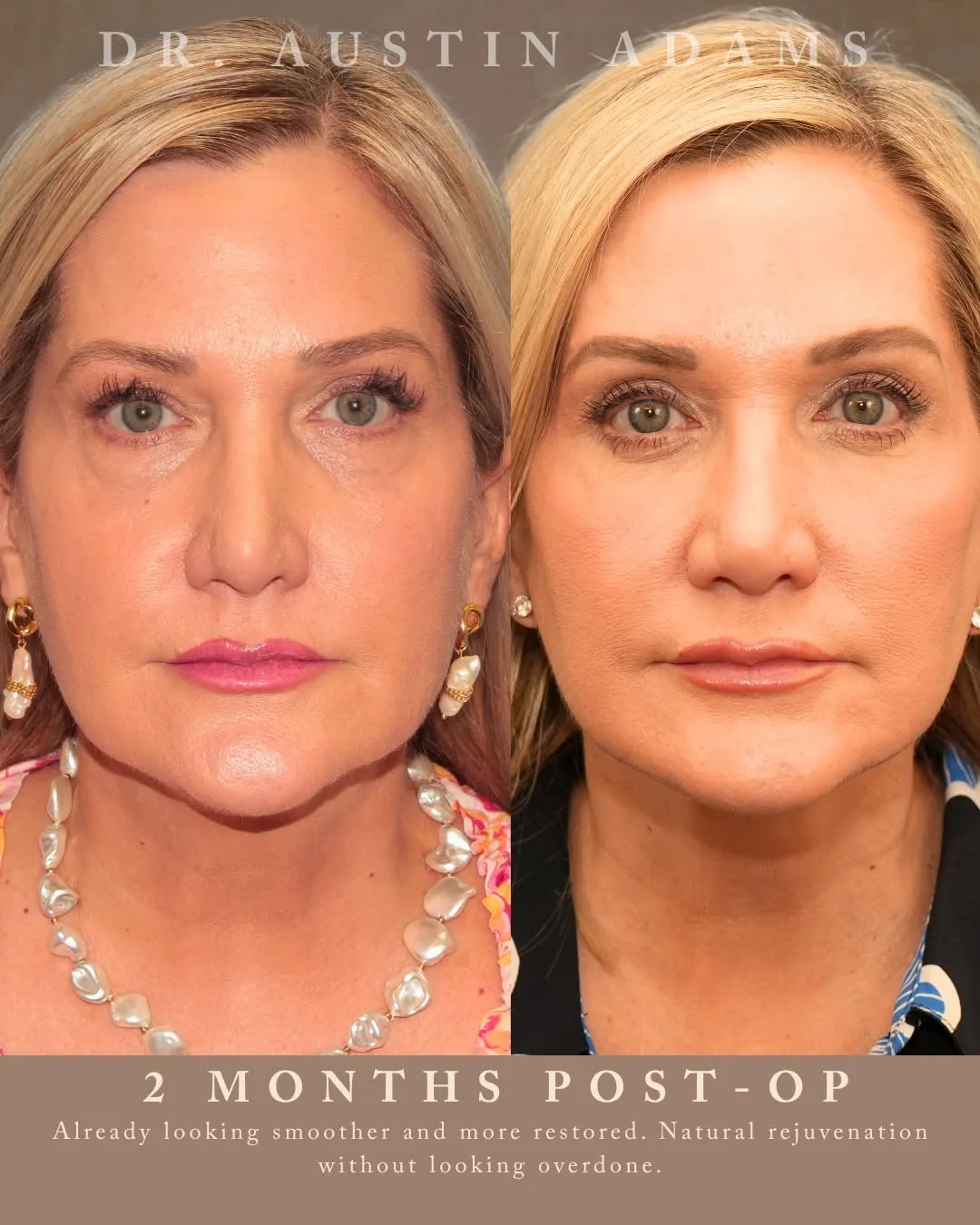 Before and after — Dr. Austin Adams