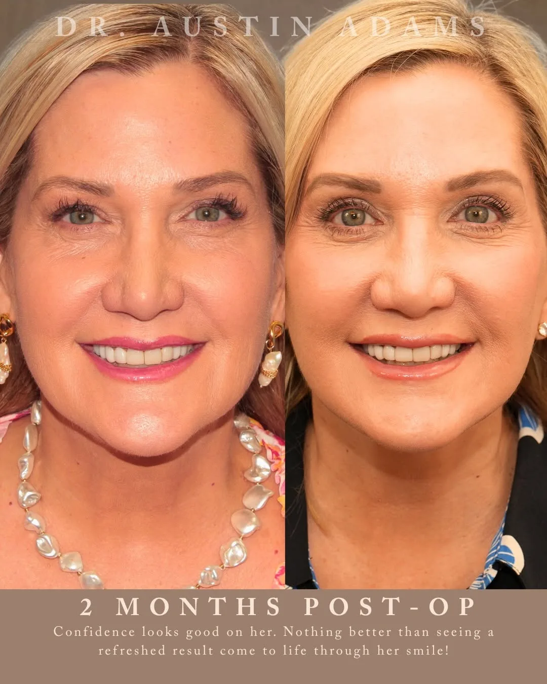 Before and after — Dr. Austin Adams