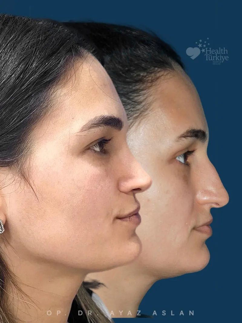 Before and after — Dr. Ayaz Aslan