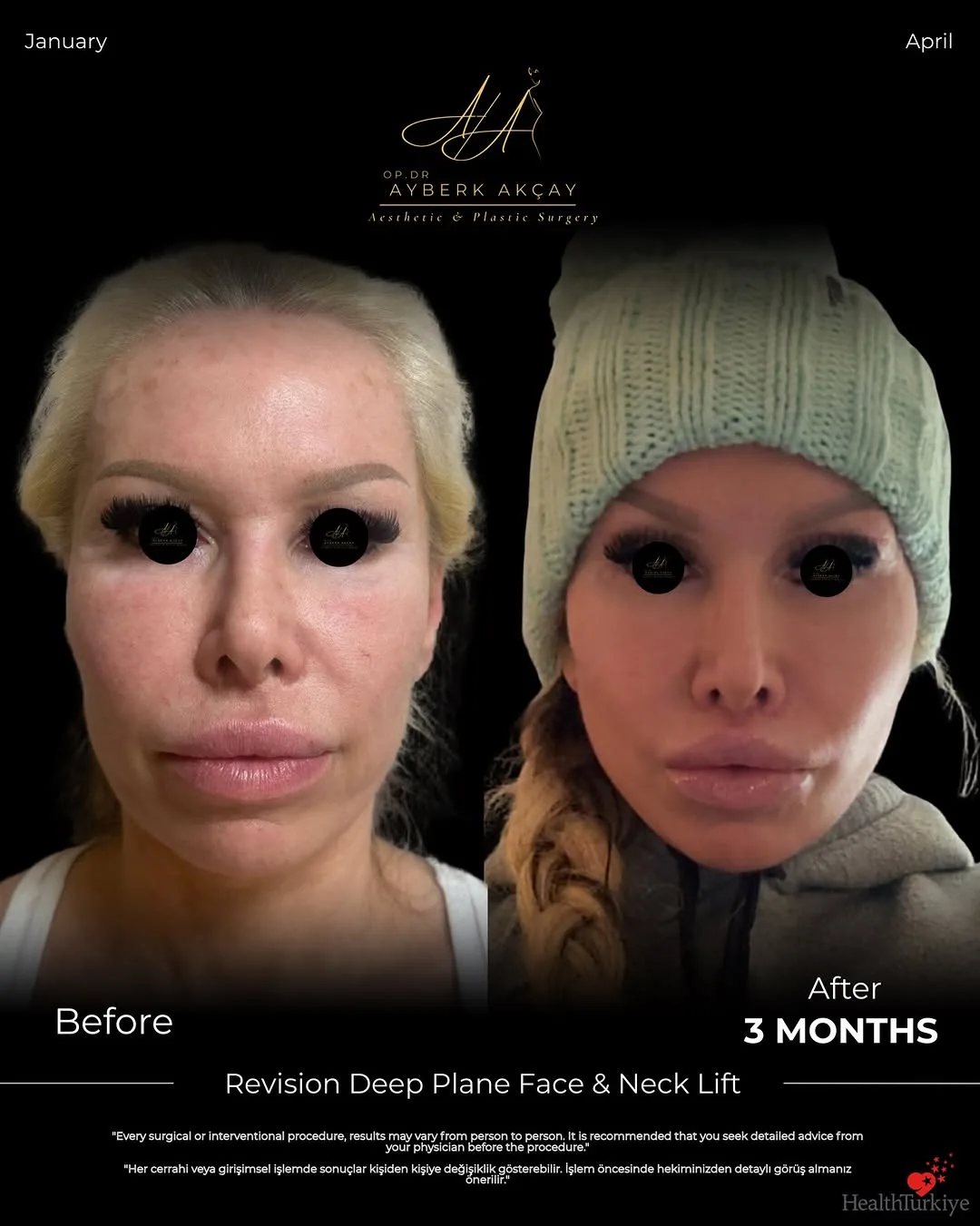 Before and after deep plane facelift — 55-year-old woman, three-quarter view, 3mo post-op by Dr. Ayberk Akçay