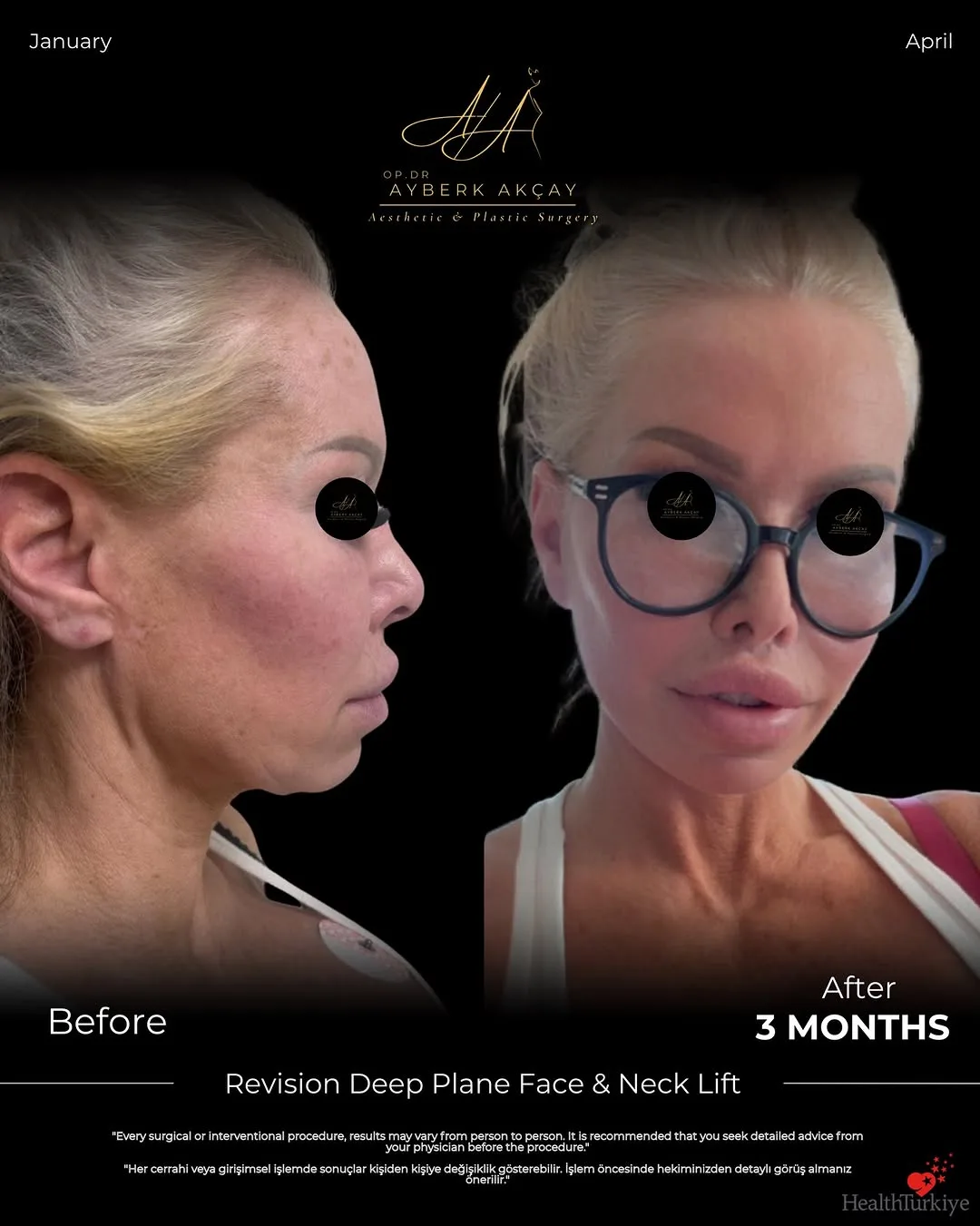 Before and after deep plane facelift — 55-year-old woman, left profile view, 3mo post-op by Dr. Ayberk Akçay