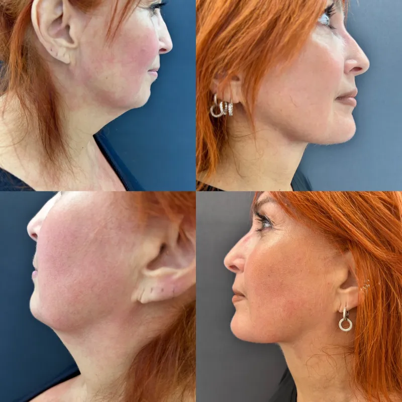 Before and after deep plane facelift, frontal view by Dr. Aykut Mısırlıoğlu