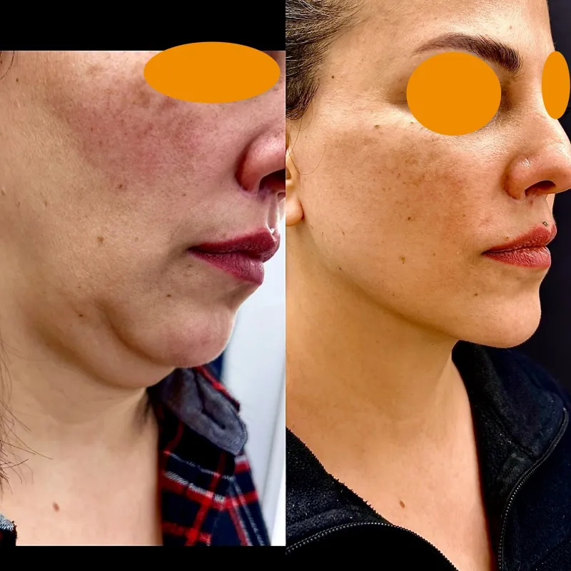 Before and after deep plane facelift, frontal view by Dr. Aykut Mısırlıoğlu