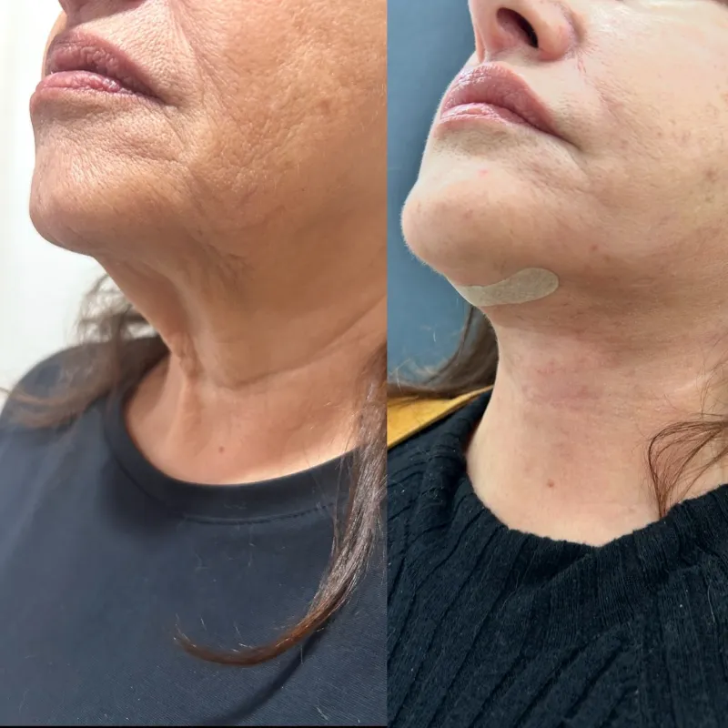 Before and after deep plane facelift, frontal view by Dr. Aykut Mısırlıoğlu