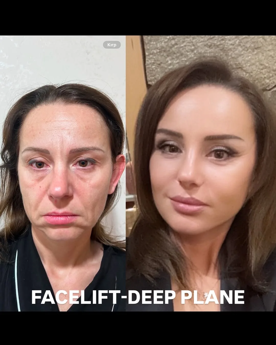 Before and after deep plane facelift — 45-year-old woman, three-quarter view, 6mo post-op by Dr. Aykut Mısırlıoğlu