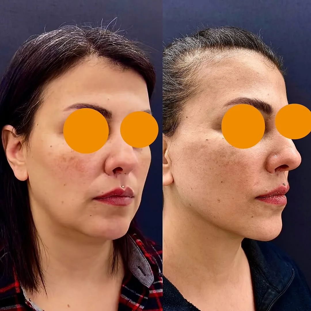 Before and after deep plane facelift — 38-year-old woman, oblique right view, 9mo post-op by Dr. Aykut Mısırlıoğlu