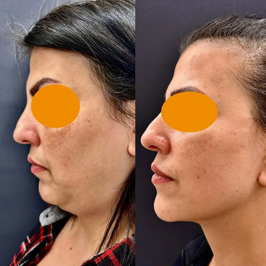 Before and after deep plane facelift — 32-year-old woman, three-quarter view, 9mo post-op by Dr. Aykut Mısırlıoğlu