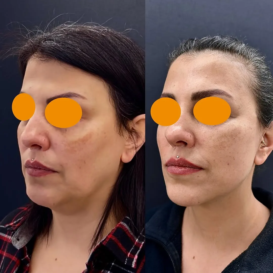 Before and after deep plane facelift — 42-year-old woman, oblique left view, 9mo post-op by Dr. Aykut Mısırlıoğlu