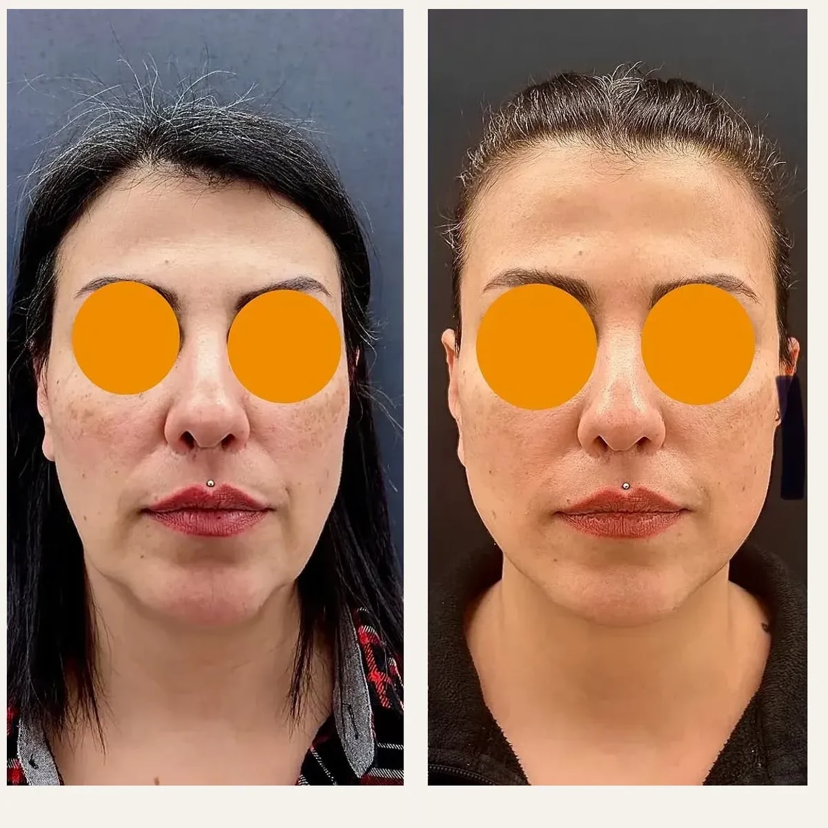 Before and after: Dr. Aykut Mısırlıoğlu