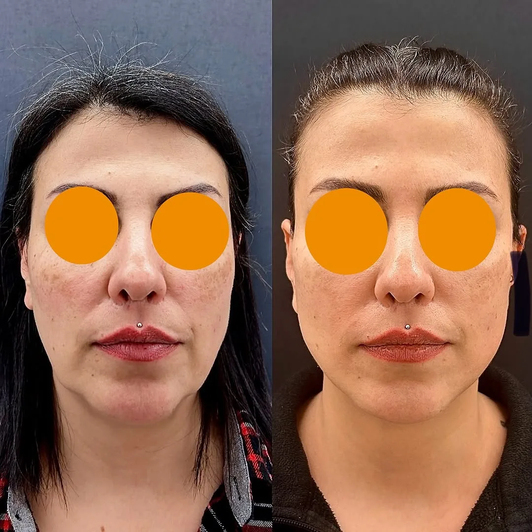 Before and after deep plane facelift — 42-year-old woman, frontal view, 9mo post-op by Dr. Aykut Mısırlıoğlu