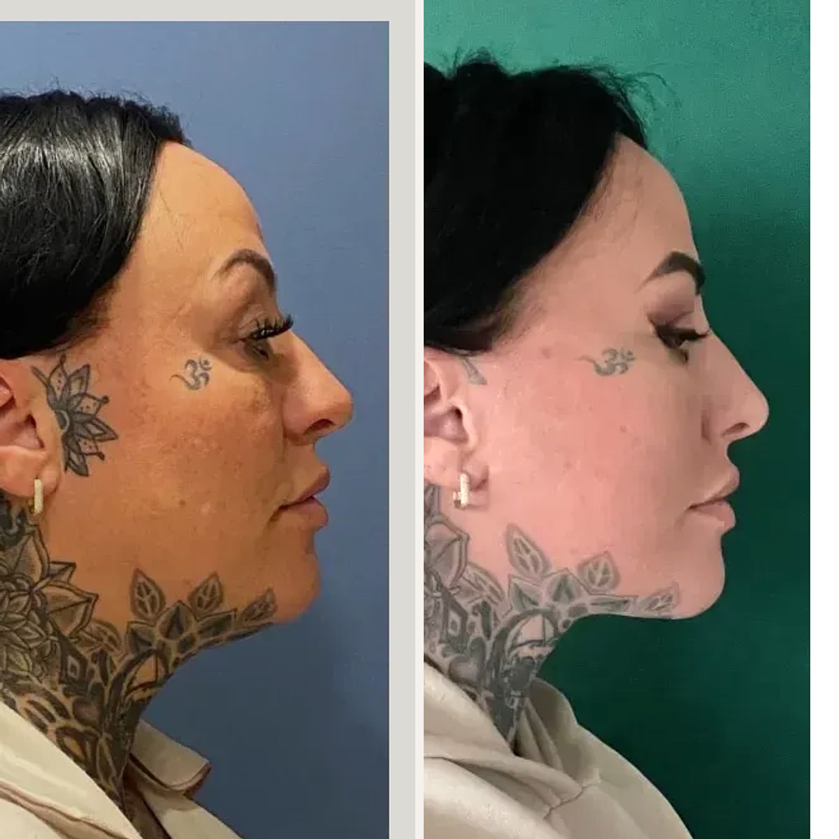 Before and after: Dr. Aziz Pars Pancı