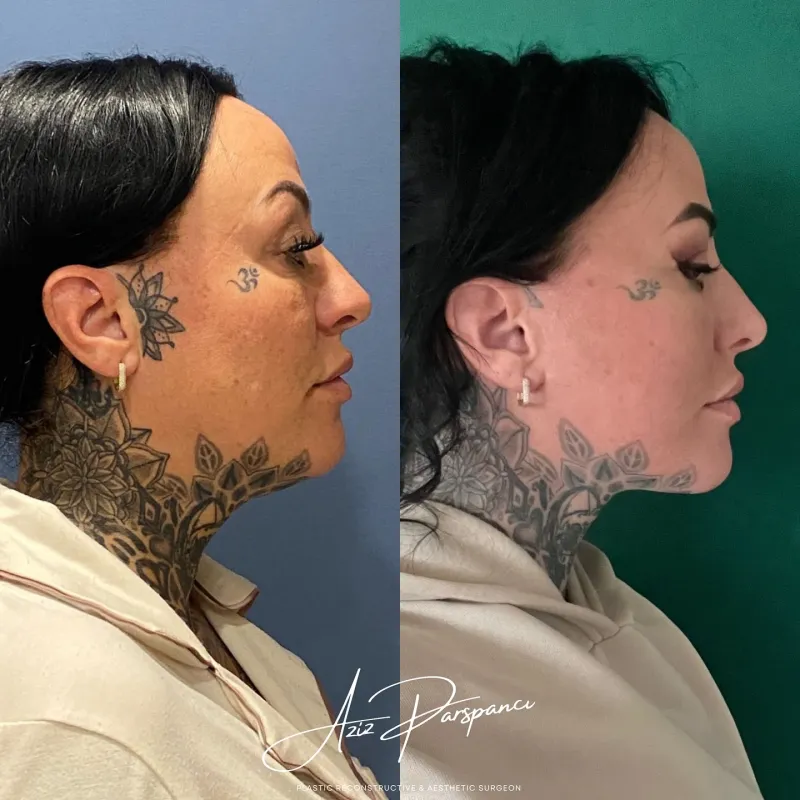 Before and after — Dr. Aziz Pars Pancı