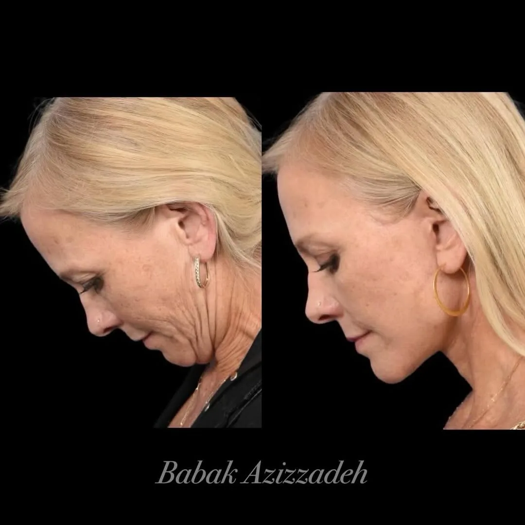 Before and after deep plane facelift — 58-year-old woman, left profile view, 3mo post-op by Dr. Babak Azizzadeh