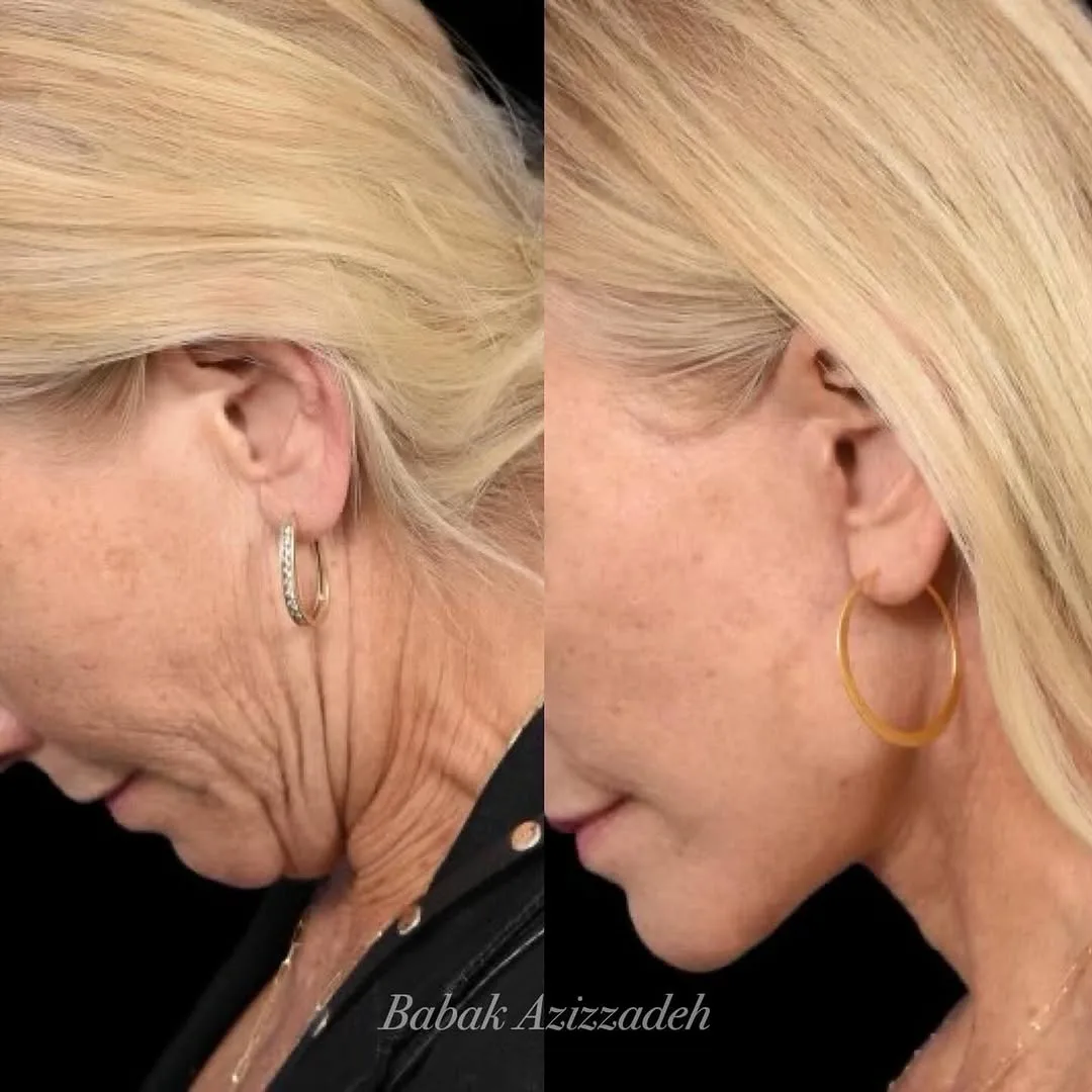 Before and after deep plane facelift — 58-year-old woman, left profile view, 3mo post-op by Dr. Babak Azizzadeh