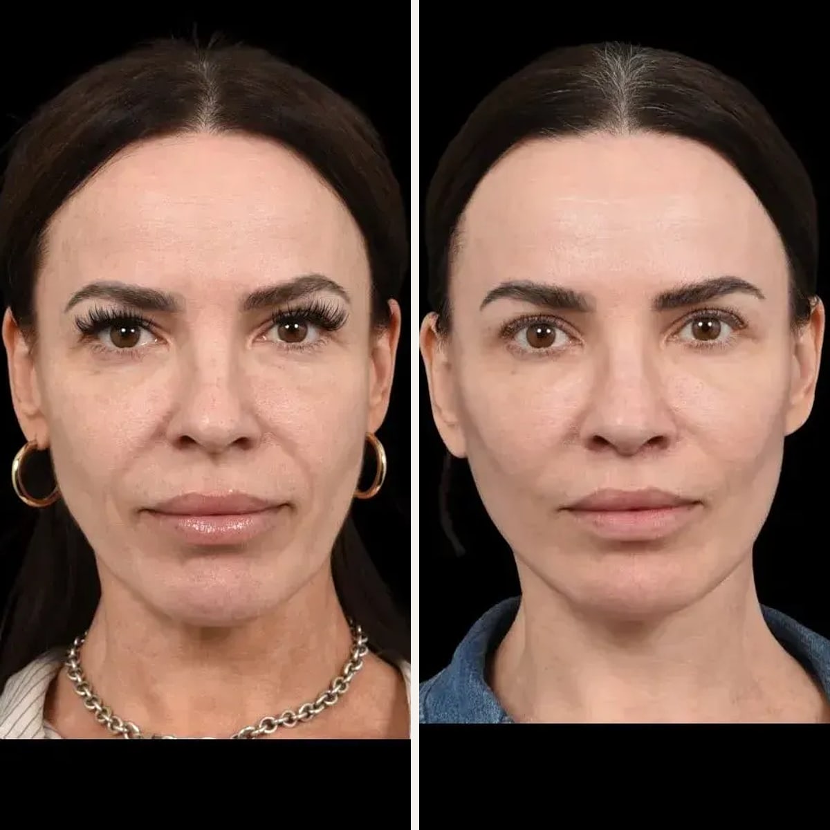 Before and after: Dr. Babak Azizzadeh