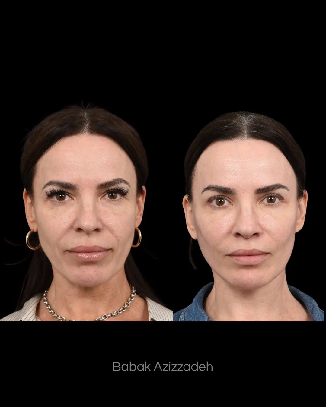 Before and after deep plane facelift — 46-year-old woman, frontal view, 3mo post-op by Dr. Babak Azizzadeh