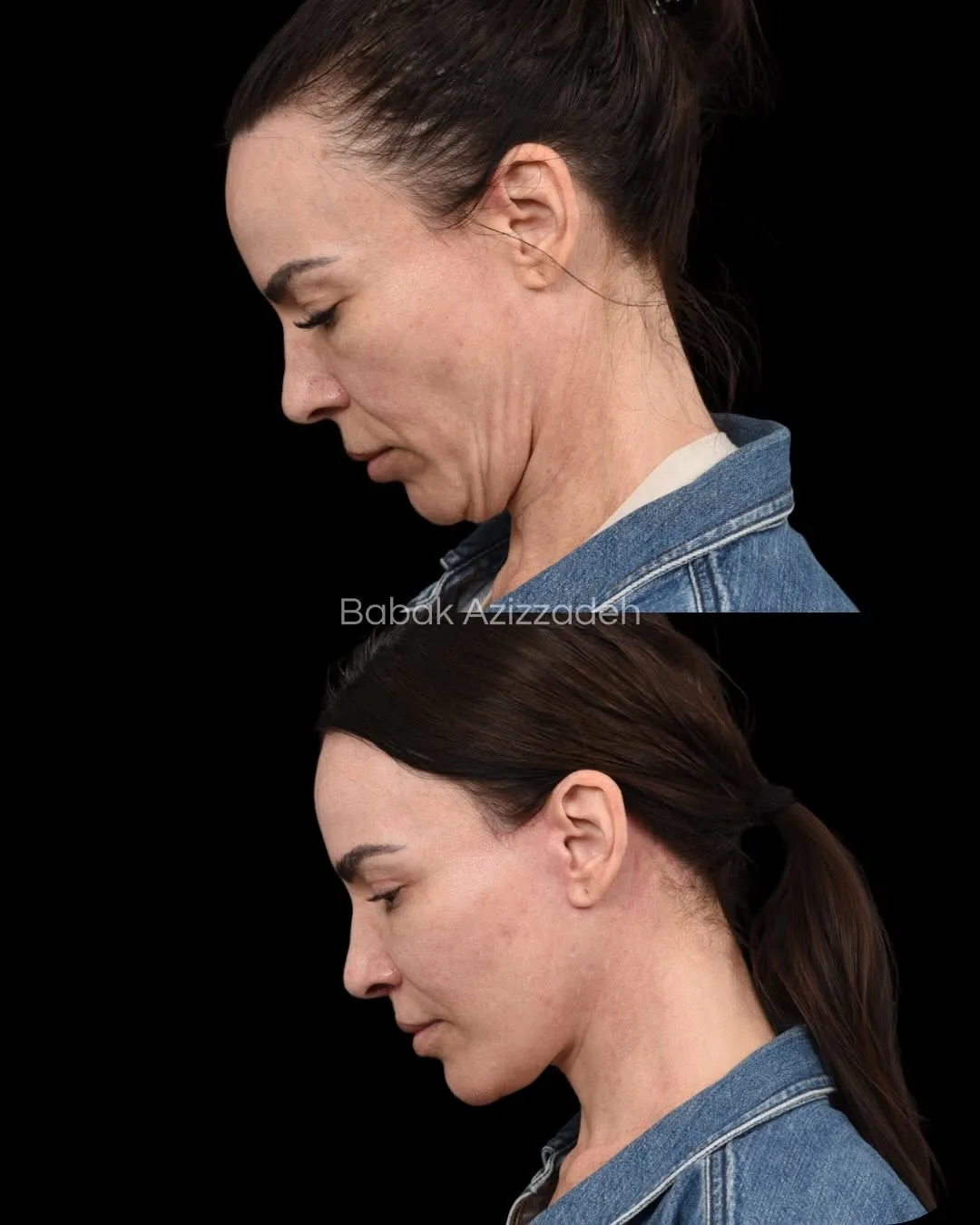 Before and after deep plane facelift — 46-year-old woman, left profile view, 7mo post-op by Dr. Babak Azizzadeh