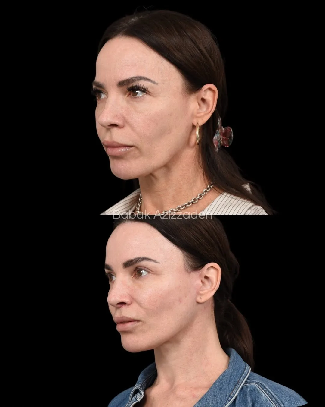 Before and after deep plane facelift — 46-year-old woman, left profile view, 9mo post-op by Dr. Babak Azizzadeh