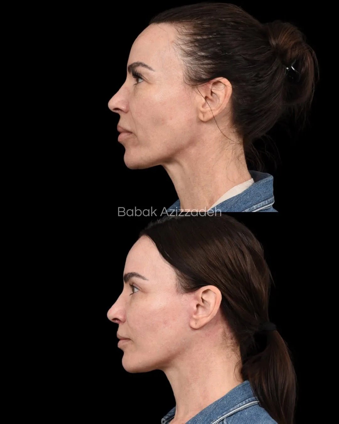 Before and after deep plane facelift — 46-year-old woman, left profile view, 9mo post-op by Dr. Babak Azizzadeh
