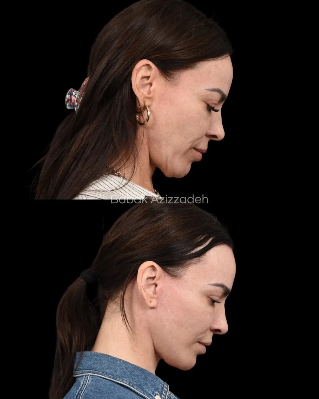 Before and after deep plane facelift — 46-year-old woman, left profile view, 12mo post-op by Dr. Babak Azizzadeh