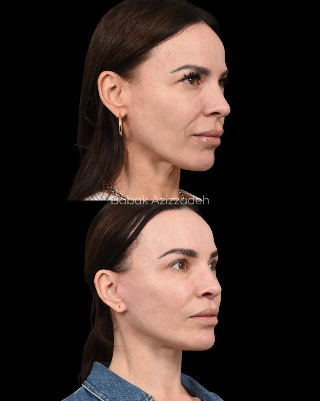 Before and after deep plane facelift — 46-year-old woman, left profile view, 9mo post-op by Dr. Babak Azizzadeh