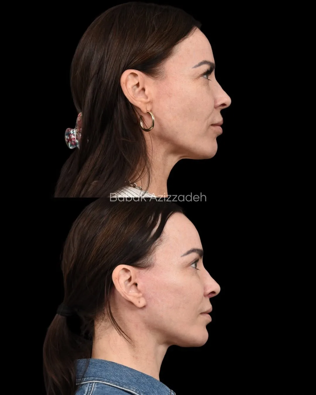 Before and after deep plane facelift — 46-year-old woman, left profile view, 9mo post-op by Dr. Babak Azizzadeh