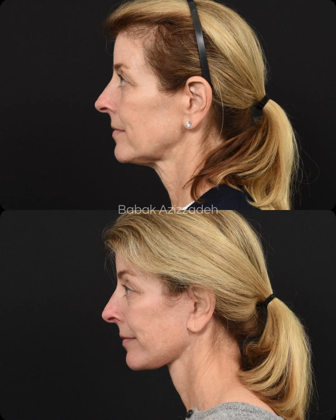 Before and after deep plane facelift — 55-year-old woman, left profile view, 4mo post-op by Dr. Babak Azizzadeh